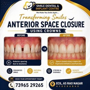 Smile Dental poster showing before-and-after of anterior space closure with crowns; diastema on left, closed spaces on right.
