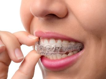 Invisalign braces