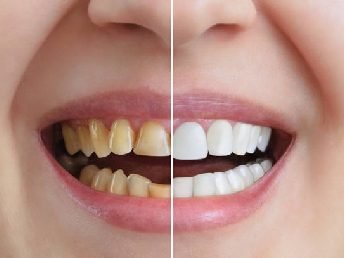 Cosmetic Dentistry